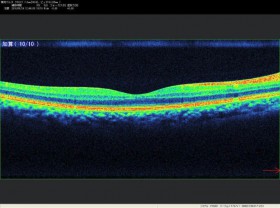 正常の黄斑部（網膜の中心）の断面の画像